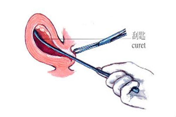 墮胎術多少費用 墮胎術多少費用